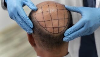 Tourisme médical : pourquoi se faire greffer les cheveux en Turquie ?